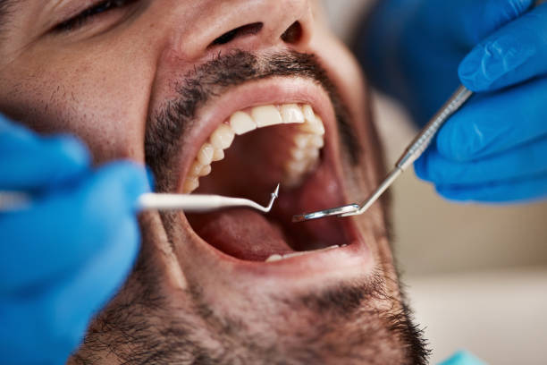 Best Broken or Chipped Tooth Repair in Thorntown, IN